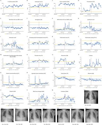 Bacterial pneumonia patients with elevated globulin levels did not get infected with SARS-CoV-2: two case reports